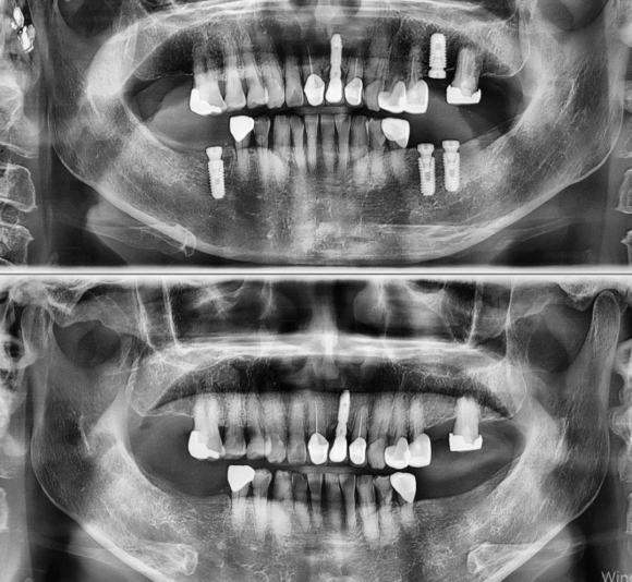 [숭실대입구역] [임플란트] 리더스진치과 2022.4.5 상/하악 임플란트 4개 관련 이미지 1
