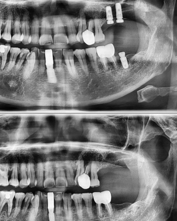 [숭실대입구역] [임플란트] 리더스진치과 2022.4.13 상악동수술/GBR AND 상악 임플란트 수술 관련 이미지 1