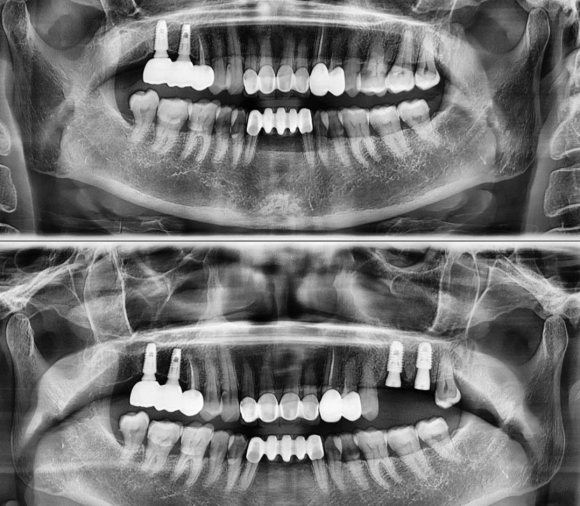 [숭실대입구역] [임플란트] 리더스진치과 2022.2.28 구치부 발치 후 즉시 임플란트/ 상악동+뼈이식 케이스 관련 이미지 1