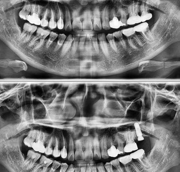[숭실대입구역] [임플란트] 리더스진치과 2022.3.5 구치부 발치 후 즉시 임플란트/ 상악동+뼈이식 케이스 관련 이미지 1
