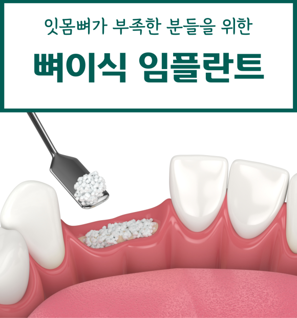잇몸뼈가 부족할땐? 관련 이미지 1