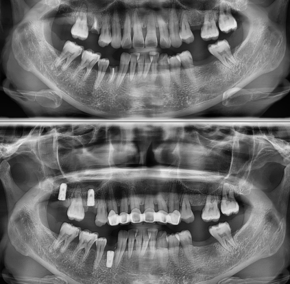 [숭실대입구역] [임플란트] 리더스진치과 2022.5.30 난발치후 즉시 임플란트 상악동수술 뼈이식 관련 이미지 1
