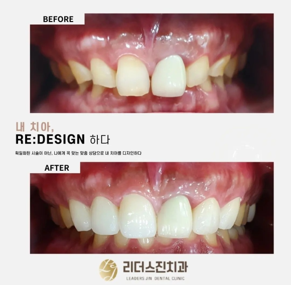 [숭실대입구역] [심미보철] 리더스진치과 심미보철 연예인보철 인플루언서치과 관련 이미지 1