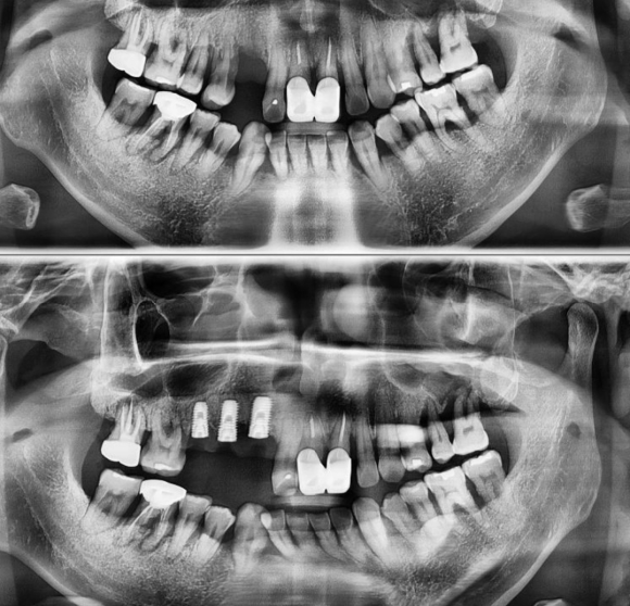 [숭실대입구역] [임플란트] 술 담배를 즐겨하는 50대 남환의 임플란트 수술. 관련 이미지 1