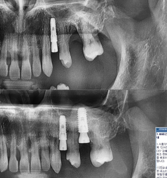 [숭실대입구역] [임플란트] 리더스진치과 2022.5.25 발치후 즉시 임플란트 상악동수술 뼈이식 관련 이미지 1