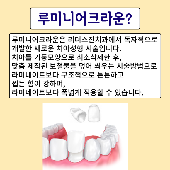 앞니 치아성형, "루미니어크라운"으로 가리지말고 당당하게 웃으세요~!!, [상도동치과 리더스진치과] 관련 이미지 2