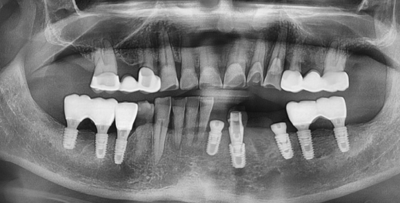 [리더스진 치과] 잇몸질환 으로 무너져버린 뼈 그리고 당일식립 임플란트 치료 전략 관련 이미지 3