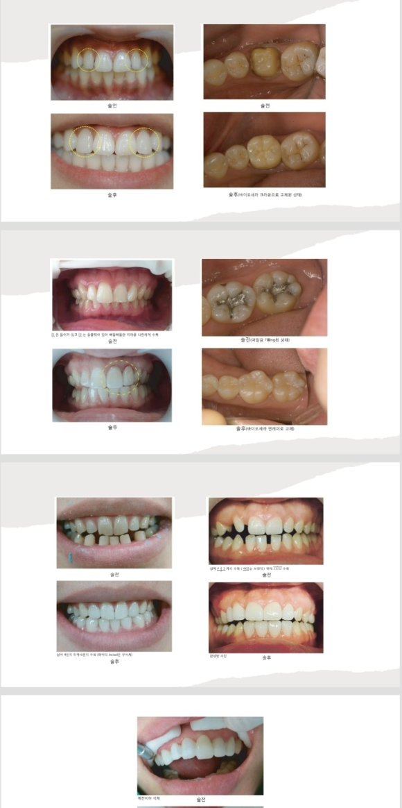 <<<<리더스진치과의 심미보철(루미니어크라운) 프로토콜>> 관련 이미지 7