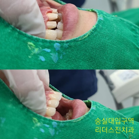 [리더스진치과] 앞니 심미보철, 앞니 크라운, 앞니 라미네이트, 무삭제 라미네이트 (?) 관련 이미지 1