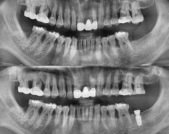[숭실대입구역] 리더스진치과 임플란트 케이스 2022.2.4 관련 이미지 1