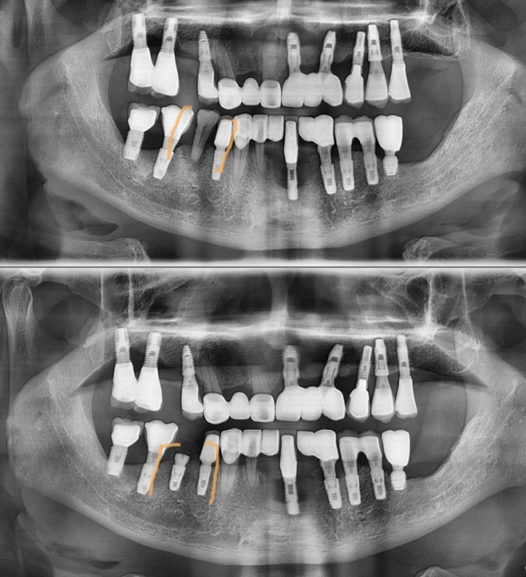 [숭실대입구역] 리더스진치과 - 발치후 즉시 식립 임플란트 & 왜 사람마다 임플란트 기간이 다르고 뼈이식 여부가 다를까? 관련 이미지 1