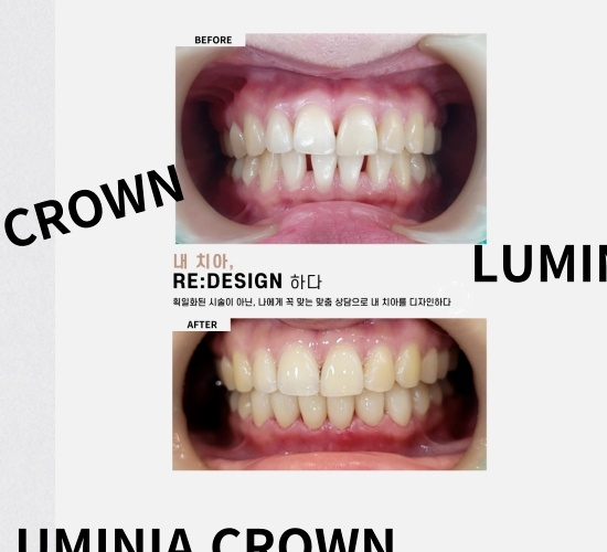 [숭실대입구역] [심미보철] 리더스진치과 심미보철 연예인보철 인플루언서치과 앞니성형 루미니어크라운 관련 이미지 1