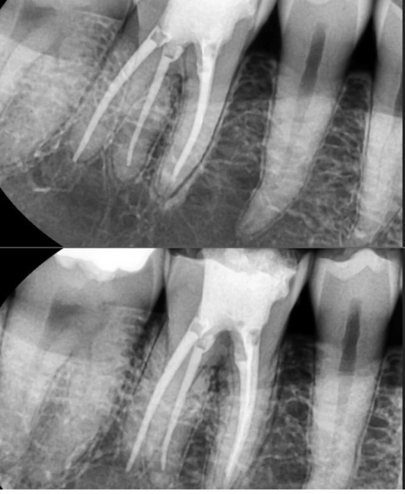 [숭실대입구역] [신경치료] 리더스진치과 2022.3.9 어금니 신경치료 관련 이미지 1