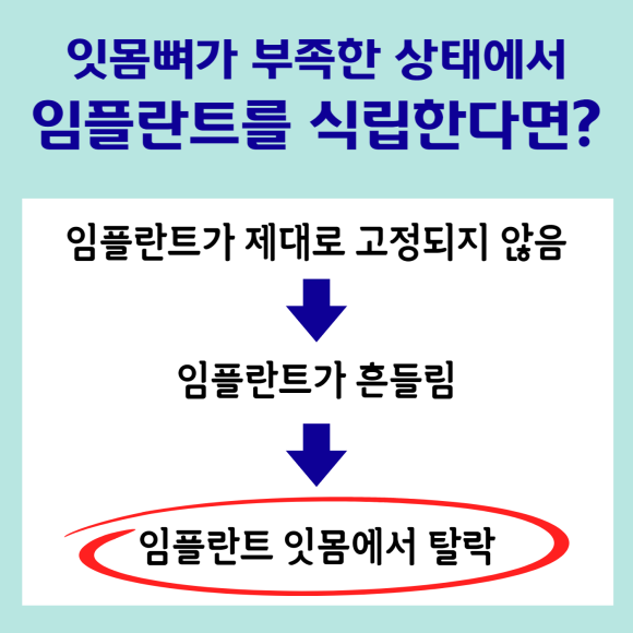 잇몸뼈가 부족할땐? 관련 이미지 4