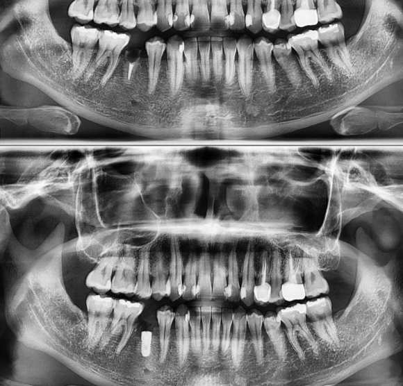 [숭실대입구역] [임플란트] 리더스진치과 2022.4.21 발치후 즉시 임플란트 + 즉시 로딩 관련 이미지 1