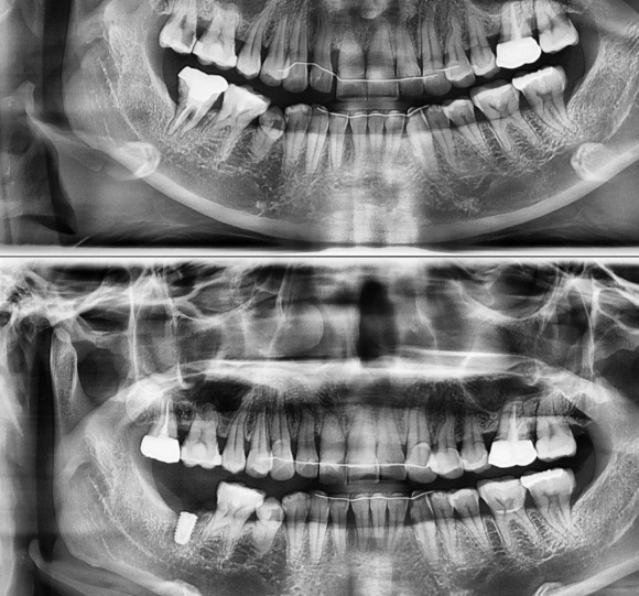 [숭실대입구역] [임플란트] 리더스진치과 2022.4.20 발치후 즉시 임플란트 식립 수술. 관련 이미지 1