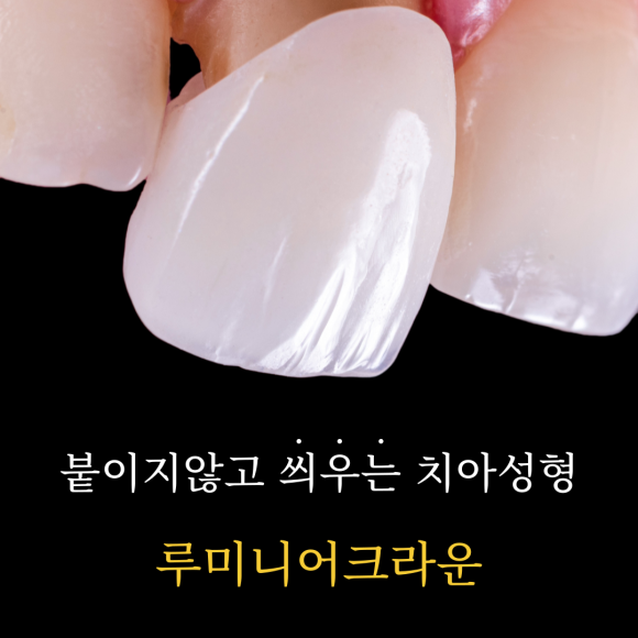 앞니깨짐, 루미니어크라운으로 깨진앞니 바로 치료하는 이유 관련 이미지 1