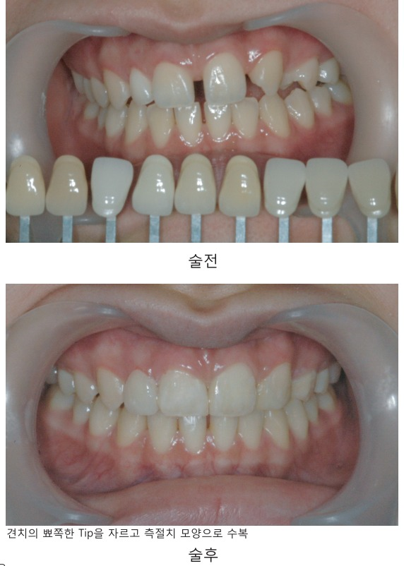 [숭실대입구역] [심미보철] 루미네이트 루미니어크라운 앞니 심미보철 완성. 관련 이미지 1