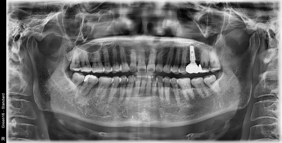무증상의 치근단 농양, 잠재적인 생명 위협 관련 이미지 5
