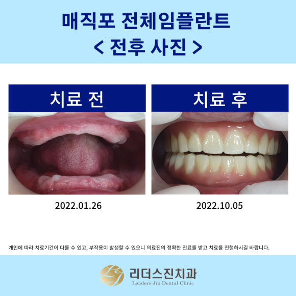 [상도동 치과] 전체임플란트 어디서 할지 고민이신가요?? 관련 이미지 5