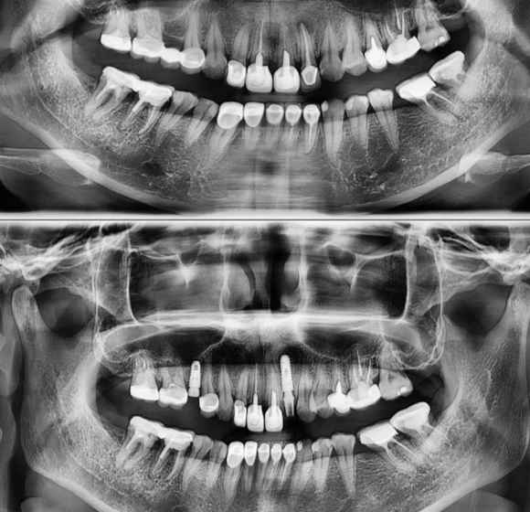[숭실대입구역] [임플란트] 60대 여환의 임플란트 식립. 관련 이미지 1