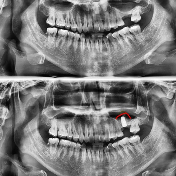 상도동 60대 임플란트 상악동 수술 뼈이식술 관련 이미지 7