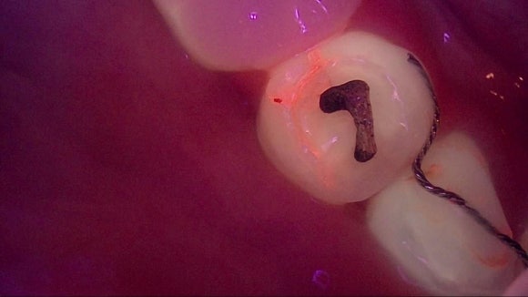 디지털 치과, 리더스진 치과의 특별한 진단 과정을 공개합니다. 관련 이미지 11