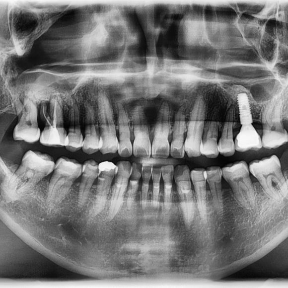 [숭실대입구역] 리더스진치과 임플란트 케이스 관련 이미지 1