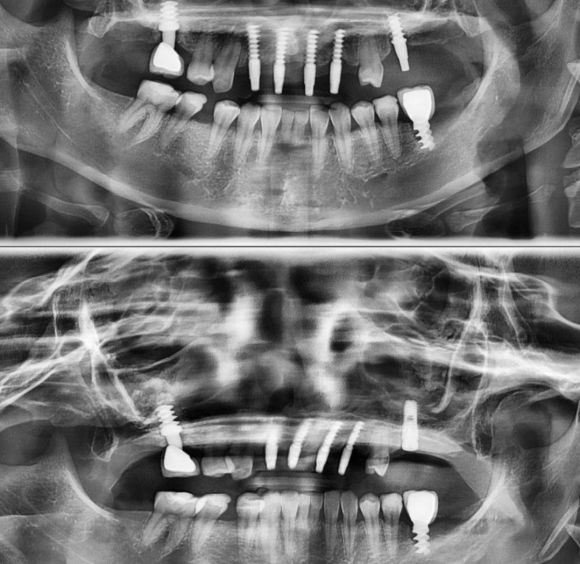 [숭실대입구역] [임플란트] 리더스진치과 2022.3.29 상악 전체 임플란트. 관련 이미지 1