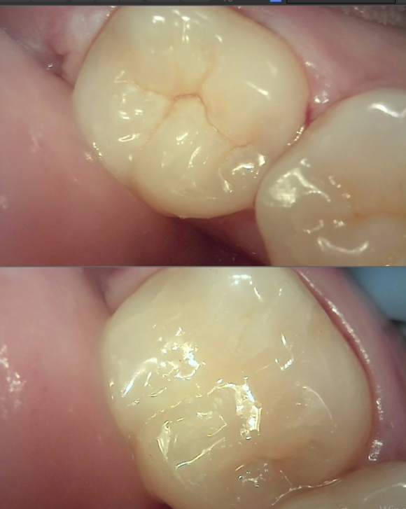 [숭실대입구역] 리더스진치과 - 충치진단기를 이용한 충치 검진과 간단한 충치치료 그리고 충치치료비용/ 치과마다 충치갯수가 다른 것을 해결하는 방법. 관련 이미지 4