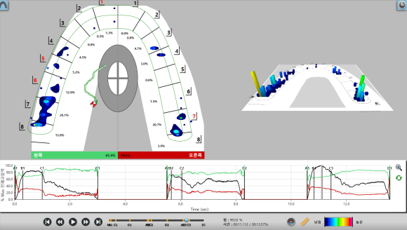 치아 교합을 정확하게 분석하는 [디지털 교합분석장비], "T-scan(티스캔)" 상도동치과, 리더스진치과 관련 이미지 4