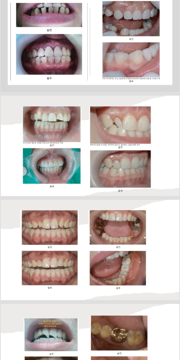 <<<<리더스진치과의 심미보철(루미니어크라운) 프로토콜>> 관련 이미지 4