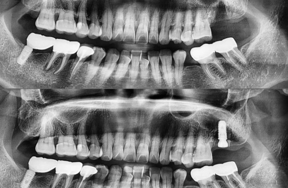 [숭실대입구역] [임플란트] 리더스진치과 2022.2.21 구치부 발치 후 즉시 임플란트/ 상악동+뼈이식 케이스 관련 이미지 1