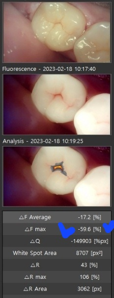[숭실대입구역] 리더스진치과 - 충치진단기를 이용한 충치 검진과 간단한 충치치료 그리고 충치치료비용/ 치과마다 충치갯수가 다른 것을 해결하는 방법. 관련 이미지 3