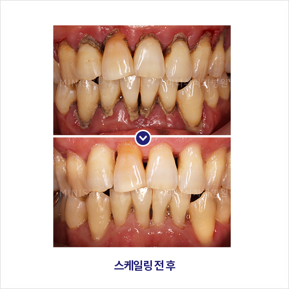 치과 스케일링의 거의 모든 것 관련 이미지 5