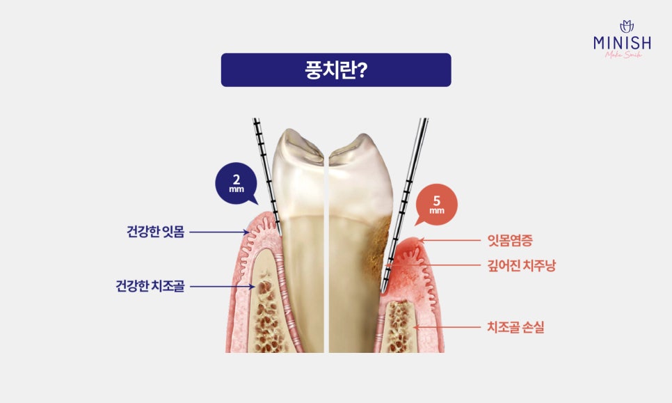 풍치치료 한계 잇몸내려앉음 핑크미니쉬로 해결! 관련 이미지 2
