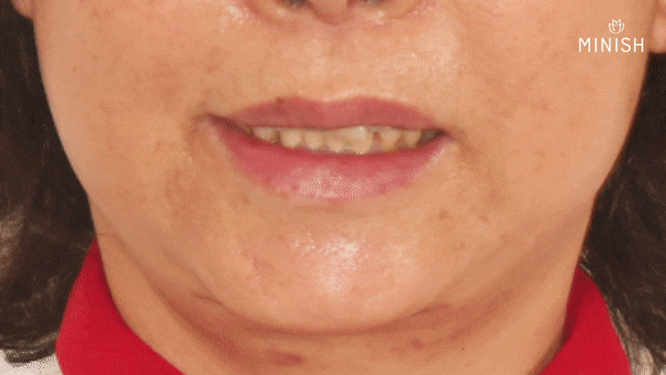 Protruding Front Teeth: How to Restore Both Health and Aesthetics When Crown Retreatment Is Needed! image 6