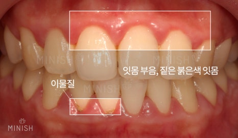 안성엄마와 딸을 괴롭힌 잇몸병 [엄마는예뻤다] 관련 이미지 15