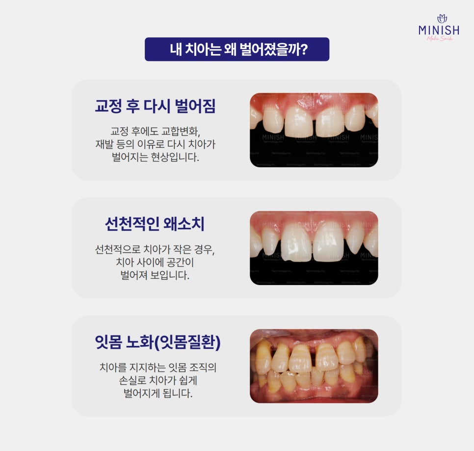 Don't Leave Gapped Teeth Visible When You Smile—Transform Them with Minishe! image 2
