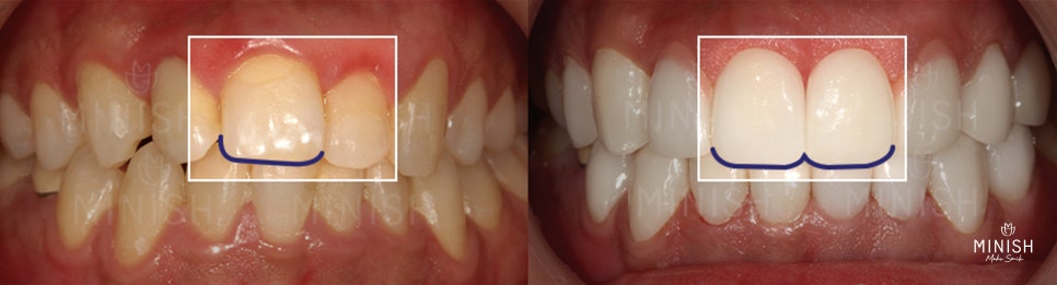 The front teeth I had worried about because of missing teeth, transformed healthily with MINISH image 2