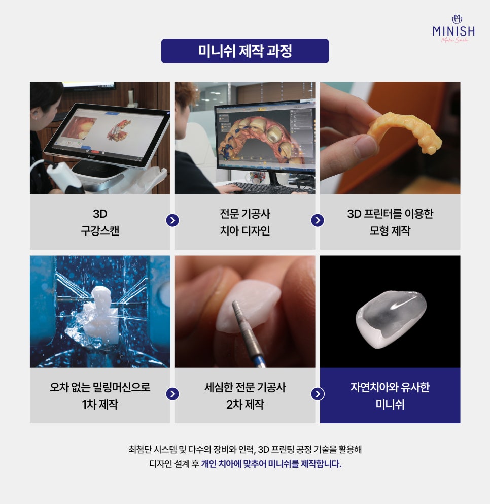 작은치아 왜소치 교정 가장 좋은 방법은? 관련 이미지 6