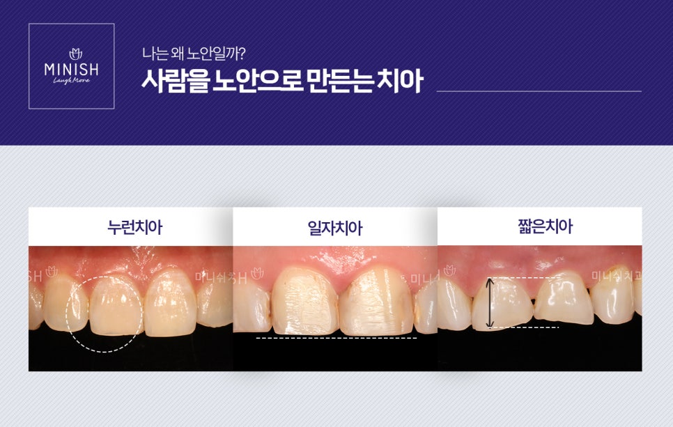 누렇고 짧은치아 개선법 관련 이미지 2