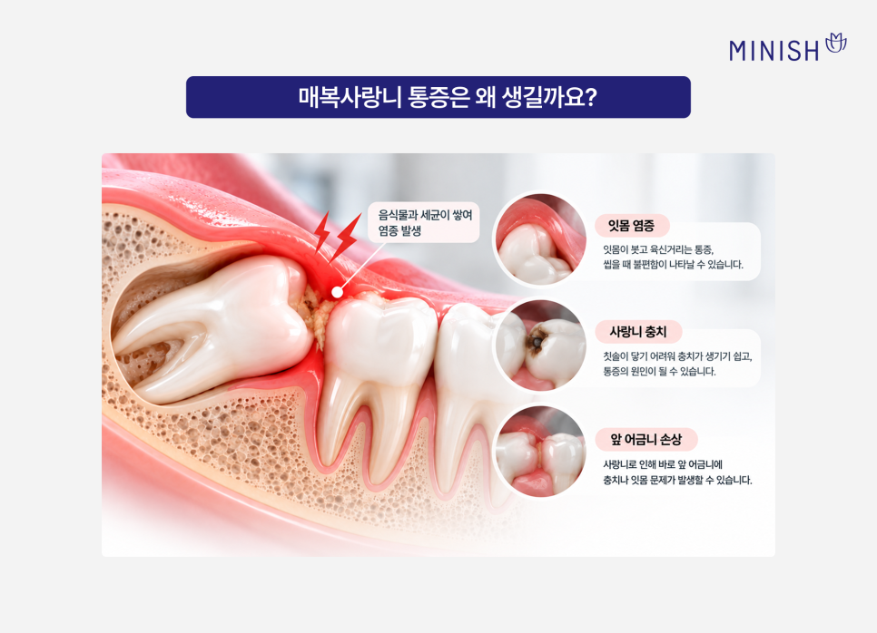 매복사랑니 통증, 발치 꼭 해야 하나요? 관련 이미지 3