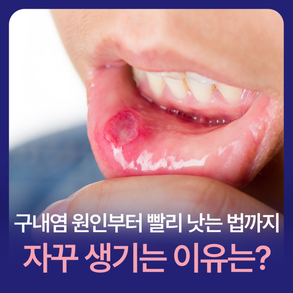 구내염 원인부터 빨리 낫는 법까지, 자꾸 생기는 이유는? 관련 이미지 1