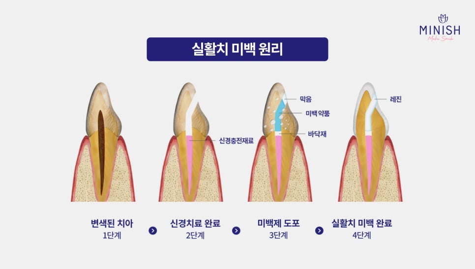Yellow Teeth Concerns: Teeth Whitening Methods That Vary by Cause image 11