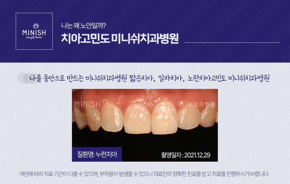 누렇고 짧은치아 개선법 관련 이미지 6