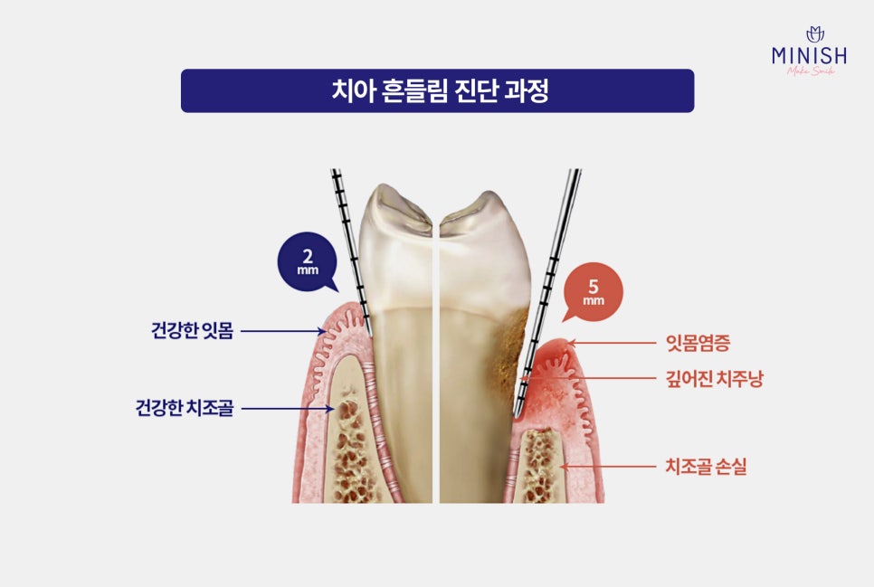강남구청역치과 치아 흔들림 원인, 방치하면 생기는 변화 관련 이미지 4