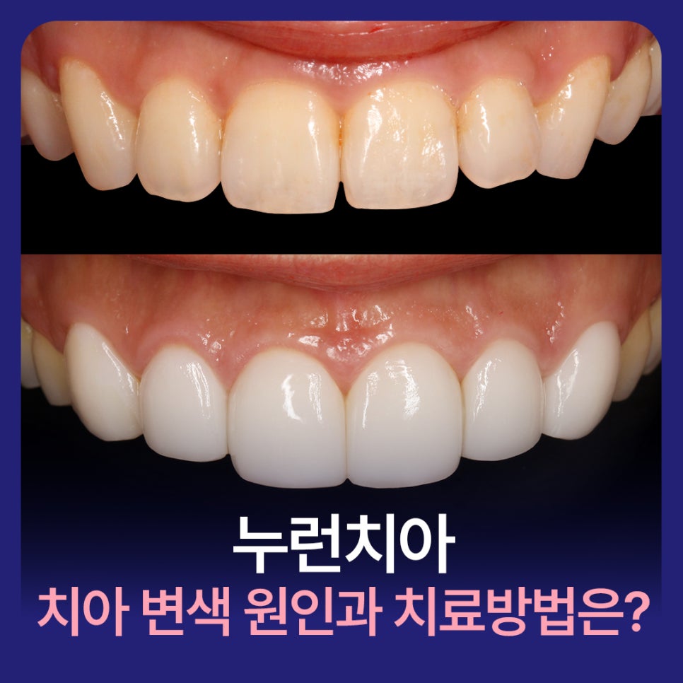 누런 치아? 치아변색 원인과 치료방법은? 관련 이미지 1