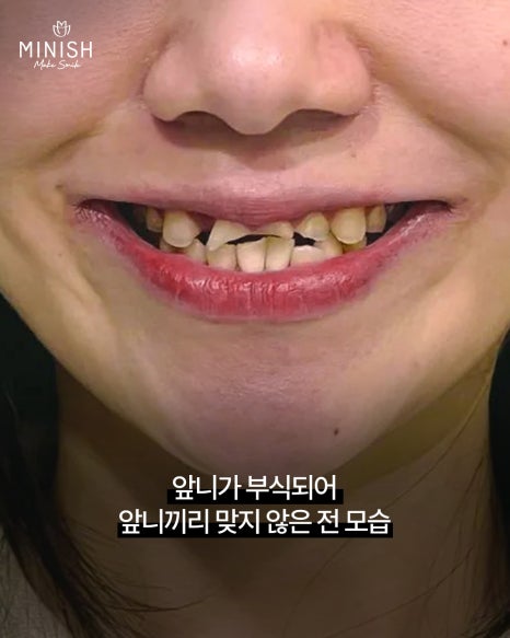 If Your Teeth Have Worn Down and Even Changed Your Face, Can They Be Restored? A Case Repaired with Minishe image 3