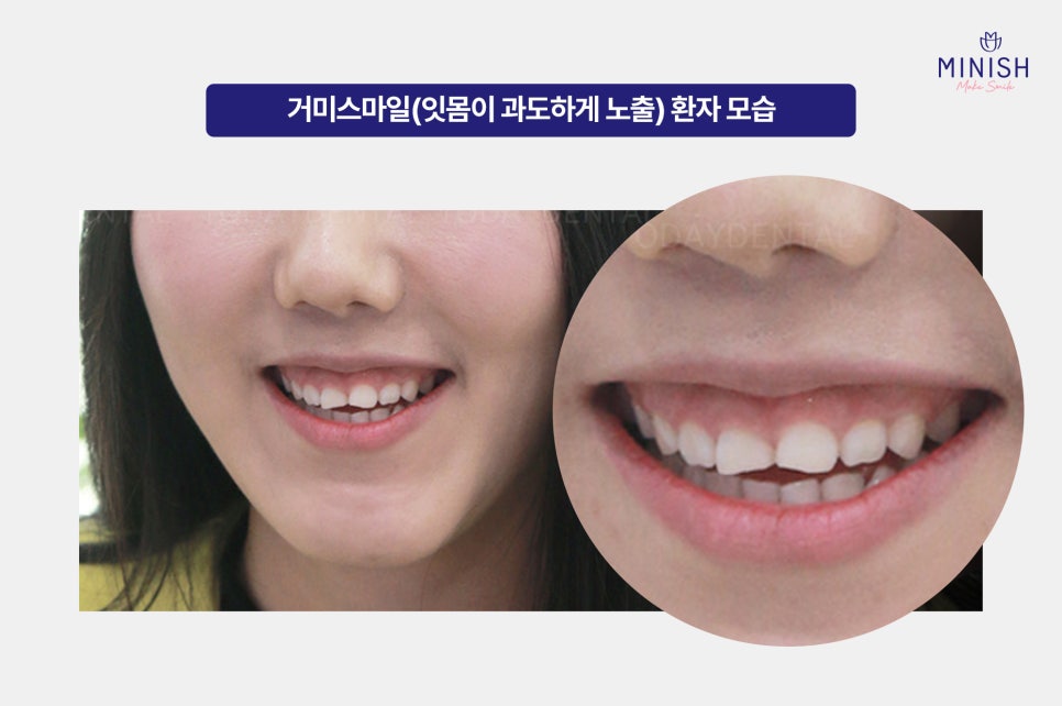 웃을 때 잇몸 과다 노출, 거미스마일 잇몸성형 알아보신다면? 관련 이미지 2